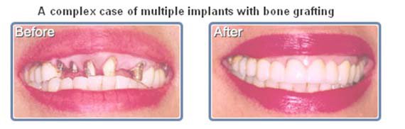 cheap dental implants bondi beach