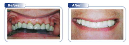 Bondi Dental | Restorative Dental Work 1 - Dentist Bondi