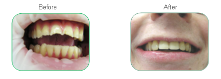 Bondi Dental | Restorative Dental Work | Dentist Bondi