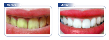 teeth whitening bondi beach