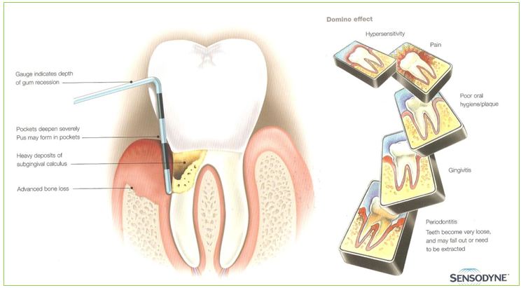Bondi Dental | The cause of Periodontal Gum Disease - Dentist Bondi