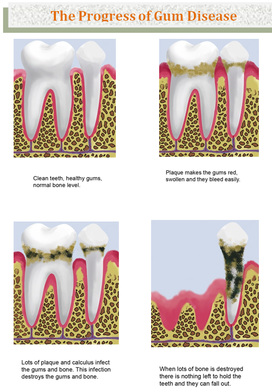 Bondi Dental | The progress of Gum Disease - Dentist Bondi