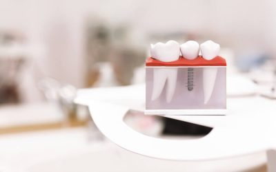 Why Dental Implants in Bondi Are The Fix to Missing Teeth