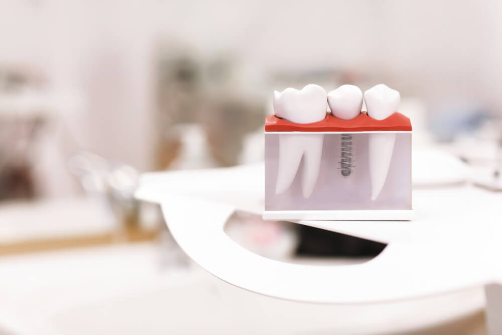 why dental implants in bondi are the fix to missing teeth