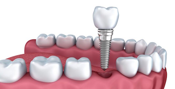 The Advantages of Getting Dental Implants