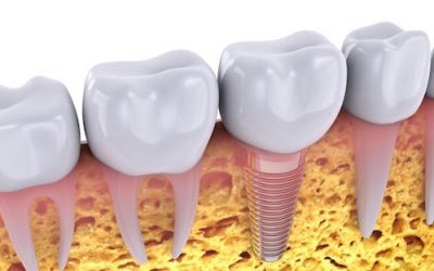 Replace Your Lost Teeth Today With Dental Implants