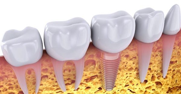 Replace Your Lost Teeth Today With Dental Implants