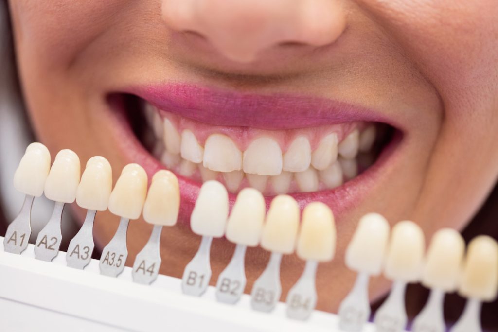 the advantages of laminated composite veneers bondi dental