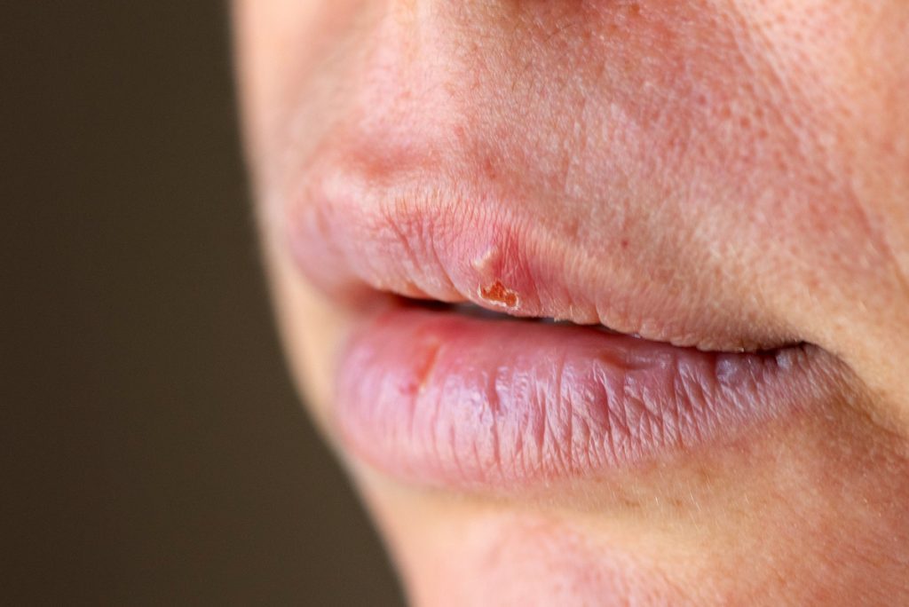 easy treatments for canker sores