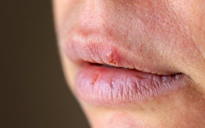 Easy Treatments For Canker Sores