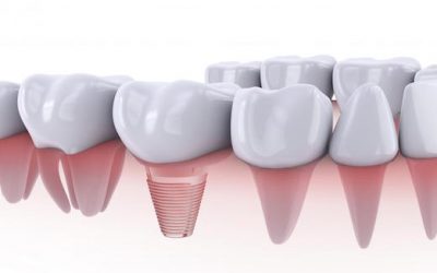 Why Consider Dental Implants Over Dentures