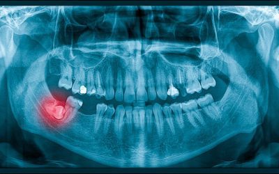 Wisdom Tooth Removal in Bondi: What to Expect Before and After
