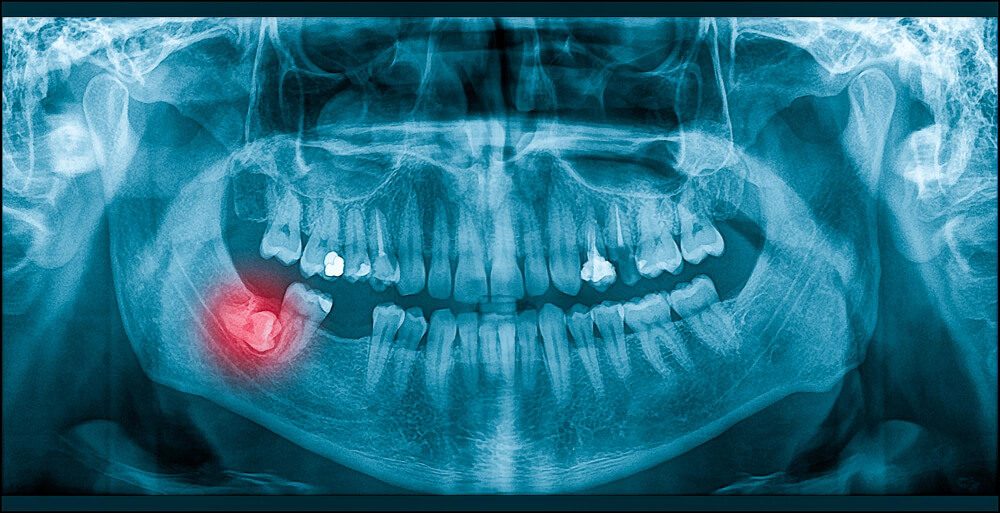 Wisdom Tooth Removal in Bondi What to Expect Before and After