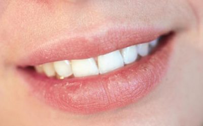 Dangers Of Dry Mouth And How Your Dentist In Bondi Can Help You