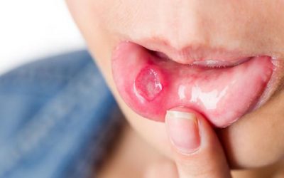 Dentist Bondi: What Causes Mouth Ulcers?