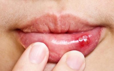 Mouth Ulcers: Canker Sores