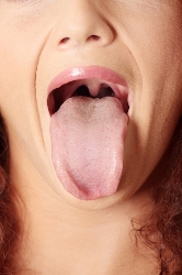 Geographic Tongue