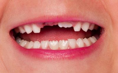 Avoiding The Consequences Of Having Missing Teeth