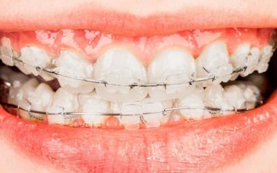 Foods to Eat and Avoid with Braces