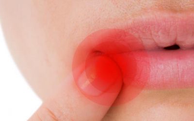 Simple Home Remedies for Mouth Sores