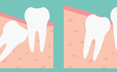 Simple Tips after your Wisdom Tooth Removal
