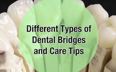 Different Types of Dental Bridges and Care Tips