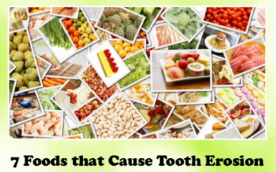 7 Foods that Cause Tooth Erosion
