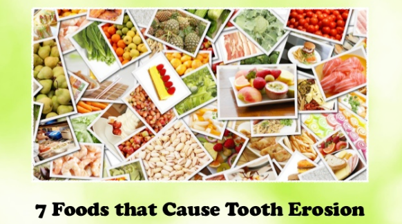 7 Foods that Cause Tooth Erosion