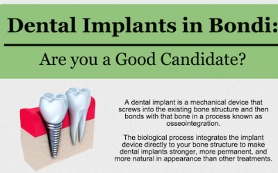 Dental Implants in Bondi: Are you a Good Candidate?