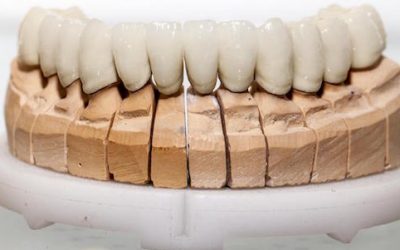 Restore Beauty and Functionality with Dental Bridges