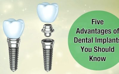 Five Advantages of Dental Implants You Should Know