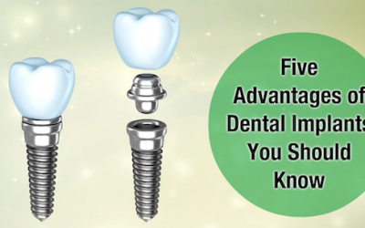 Five Advantages of Dental Implants You Should Know