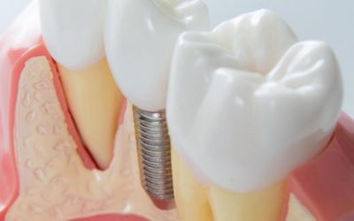 5 Questions to Ask When Searching about Dental Implants in Bondi