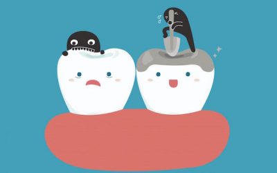 The Role of Dental Sealants in Tooth Decay Prevention