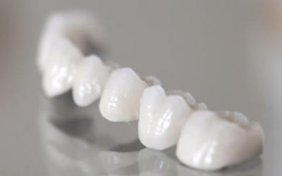6 Reasons to Choose Dental Bridges in Bondi