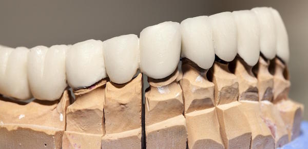 How Long Will Dental Crowns Last?