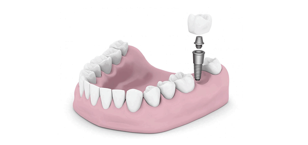 Top 5 Myths about Dental Implants