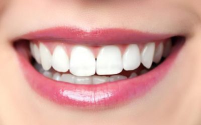 5 Reasons to Choose Dental Veneers in Bondi