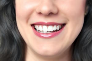 5-reasons-to-choose-dental-veneers-in-bondi-bondi-dentist