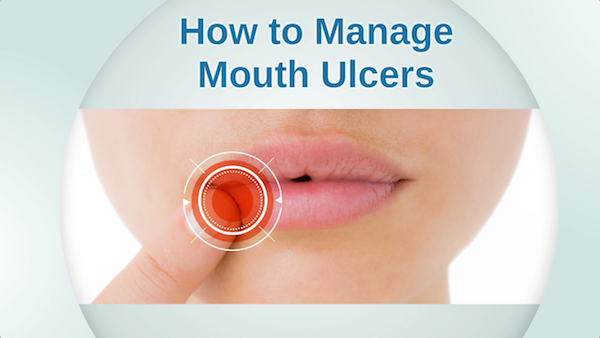 How to Manage Mouth Ulcers