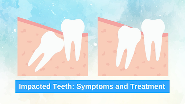How To Know If You Have Impacted Teeth