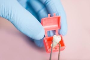 Wisdom Teeth Removal | Dentist Bondi