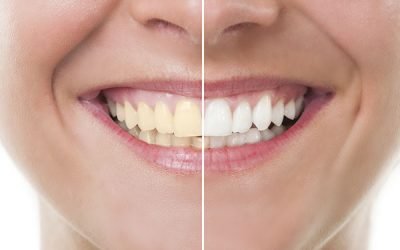 How To Get Rid of Yellow Teeth Overnight