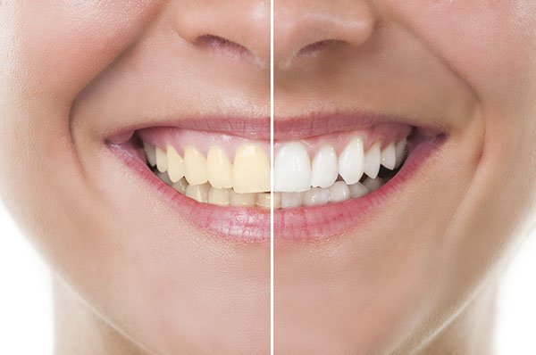 How to Get Rid of Yellow Teeth  