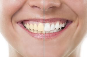 Bondi Dental | Professional Teeth Whitening in Bondi – Safe, Fast, Long-lasting | Dentist Bondi