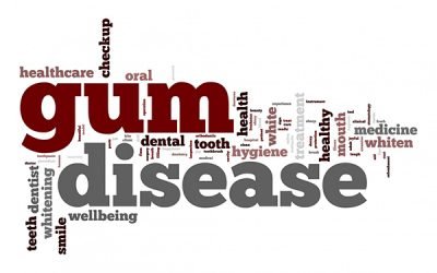 Gum Disease – Causes, Protection, Cures