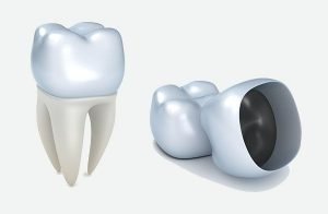 dental crowns Bondi Beach