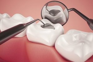 lost/damaged tooth restorations bondi