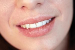 Dry Mouth Causes Remedies and Treatment | Dentist Bondi