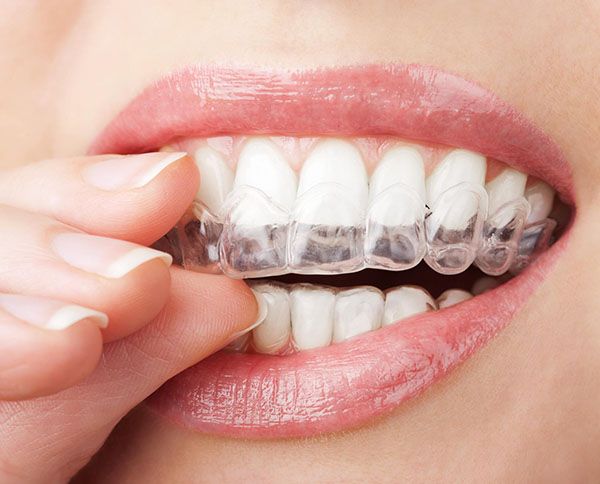 Six Incredible Invisalign Tips & Tricks at Bondi Dental